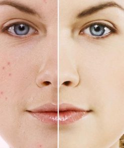 Alternative view of Masca faciala Anti-Acnee japoneza Lululun